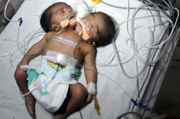 Un bébé à deux têtes en Inde